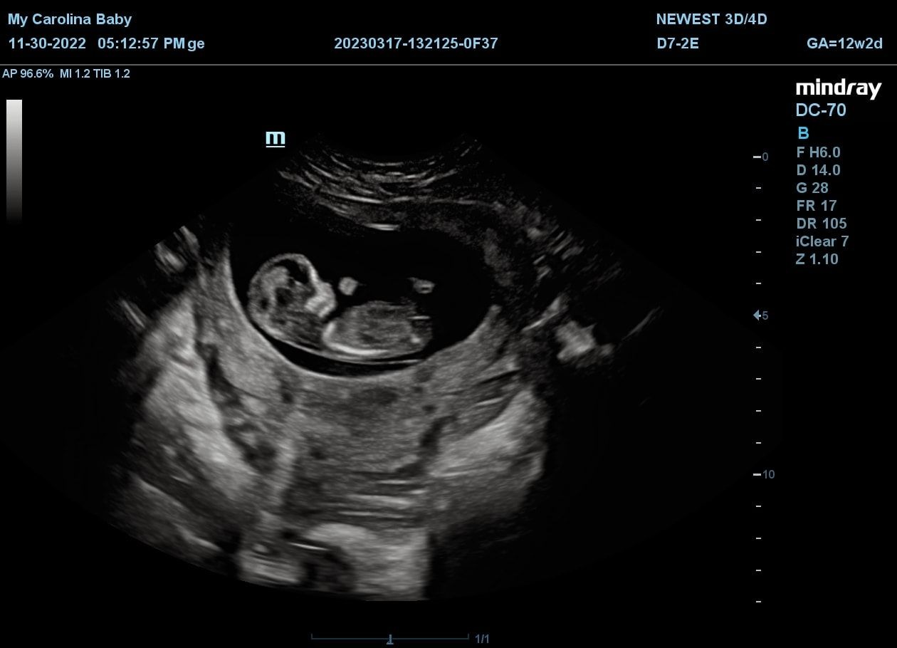 We were told everything was fine and she was healthy at this doctor, only to learn that everything was okay at 31 weeks.